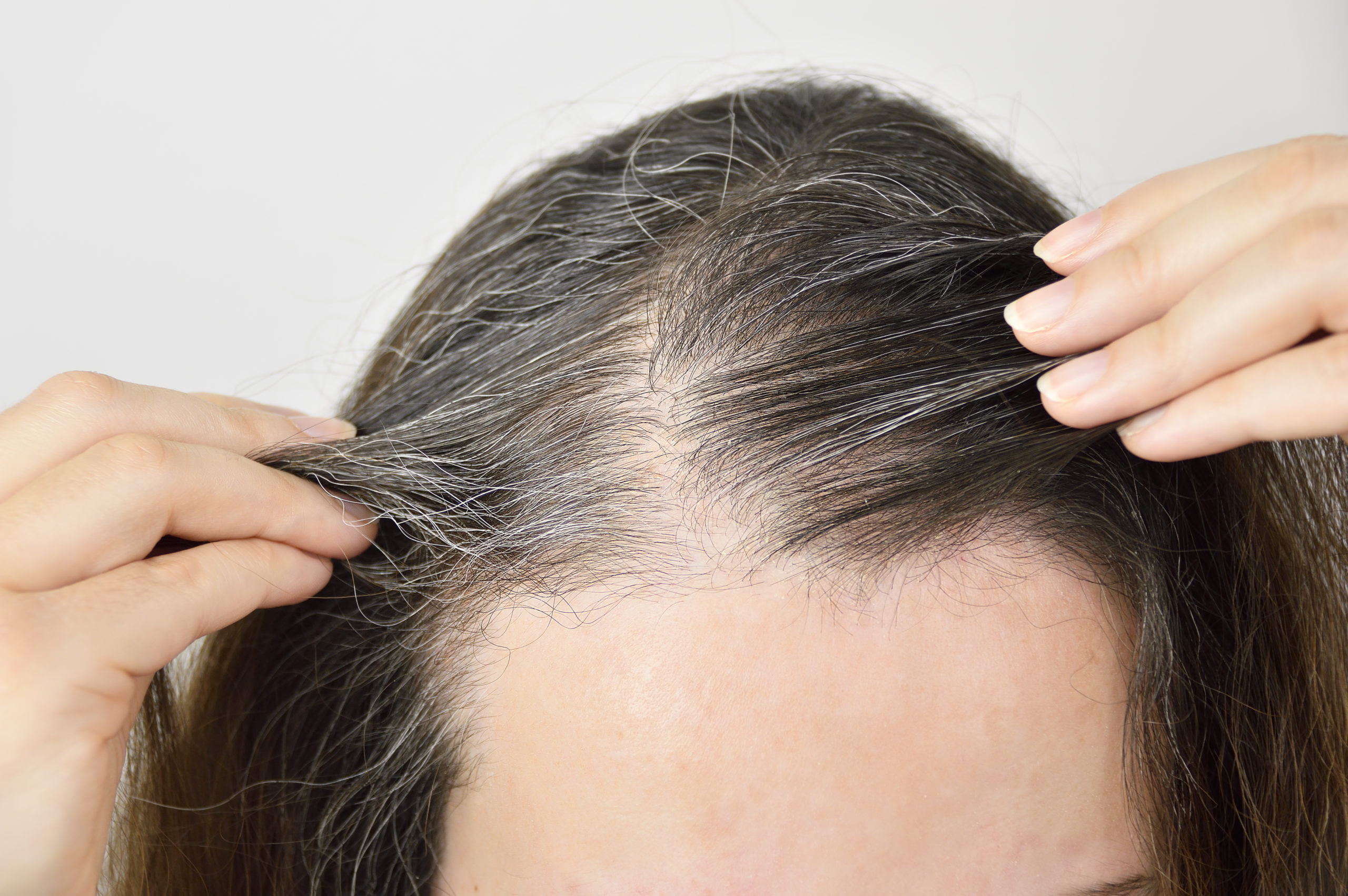 Things To Know About Effective Hair Loss Treatments